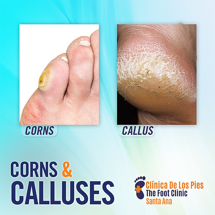 Corns and Calluses - Prevention and Treatment - Eclipse Foot Clinic
