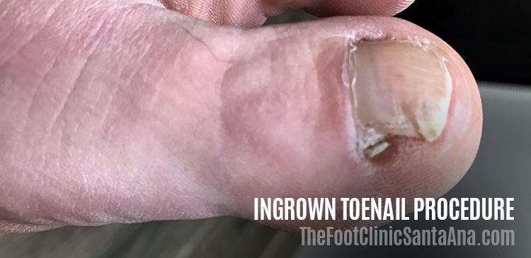 Ingrown Toenail The Foot Clinic Santa Ana