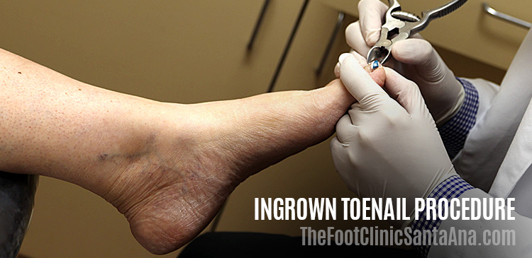 Ingrown Toenail Procedure - Prior to surgery - Clinica de los Pies Santa Ana - TheFootClinic.com