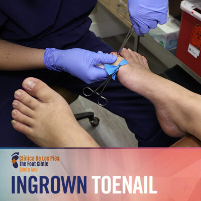 Ingrown Toenails - Petrolia Foot Clinic
