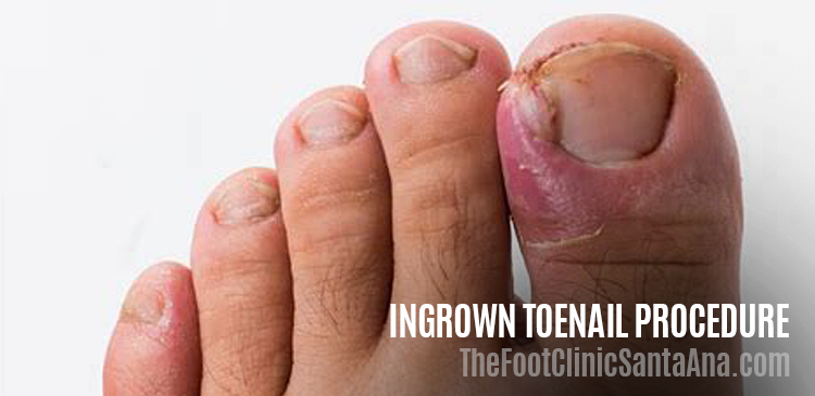 Home Care for an Ingrown Toenail: South Sound Foot & Ankle: Podiatric  Medicine and Surgery